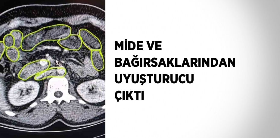 MİDE VE BAĞIRSAKLARINDAN UYUŞTURUCU ÇIKTI