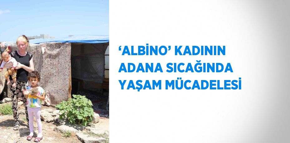 ‘ALBİNO’ KADININ ADANA SICAĞINDA YAŞAM MÜCADELESİ