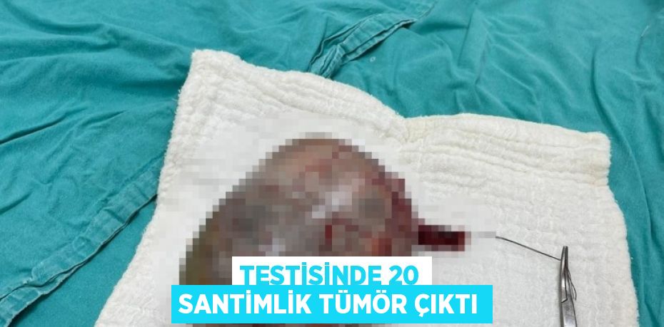 Testisinde 20 santimlik tümör çıktı