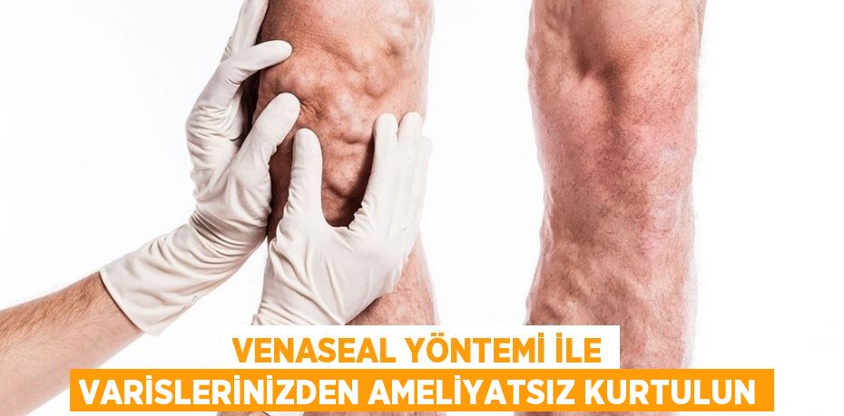 VENASEAL YÖNTEMİ İLE VARİSLERİNİZDEN AMELİYATSIZ KURTULUN