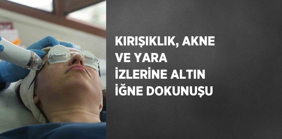 KIRIŞIKLIK, AKNE VE YARA İZLERİNE ALTIN İĞNE DOKUNUŞU